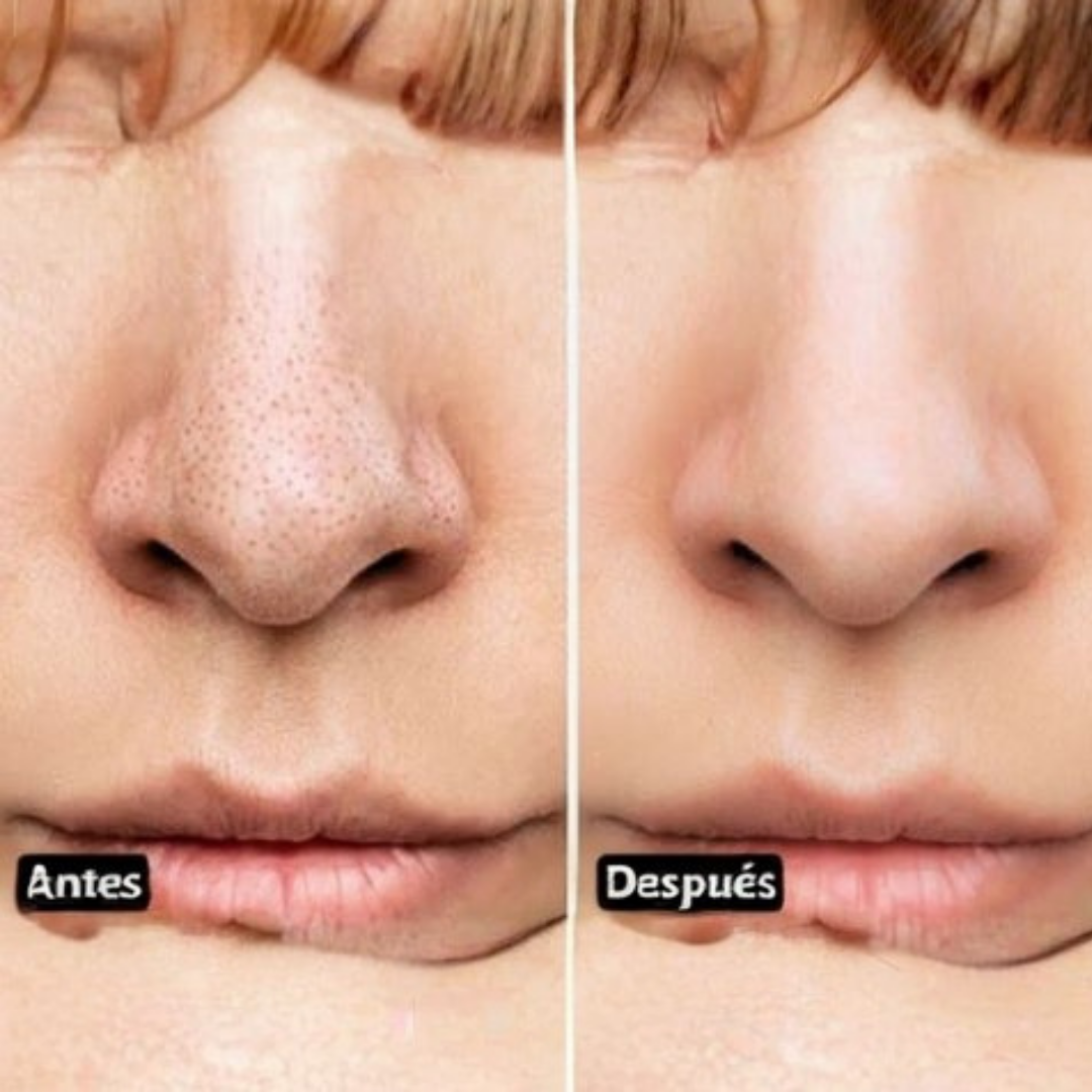 Removedor de Impurezas DermaVac Pro